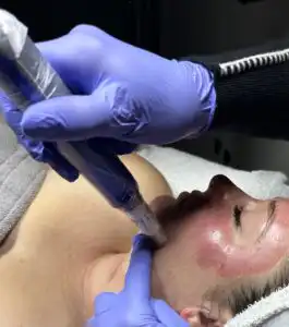 skinpen-at-scg-spa
